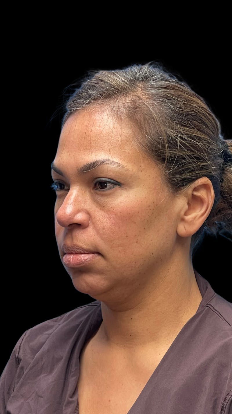 ContourLift Before & After Gallery - Patient 361287 - Image 7