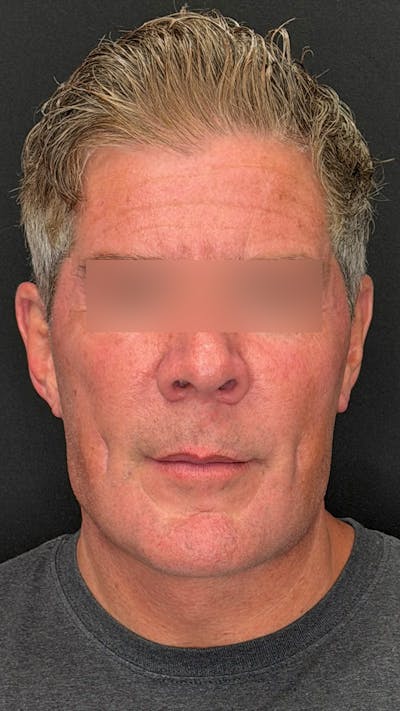 Deep Plane Facelift 50s Before & After Gallery - Patient 253190 - Image 2