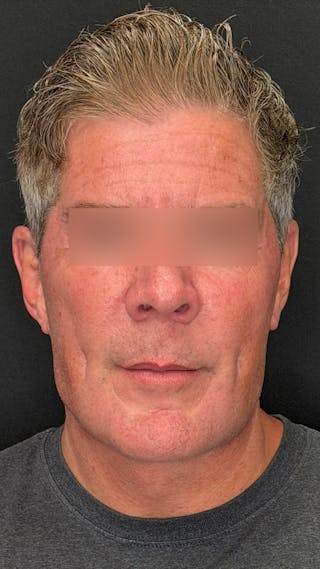 Cheek Implant Before & After Gallery - Patient 350990 - Image 2