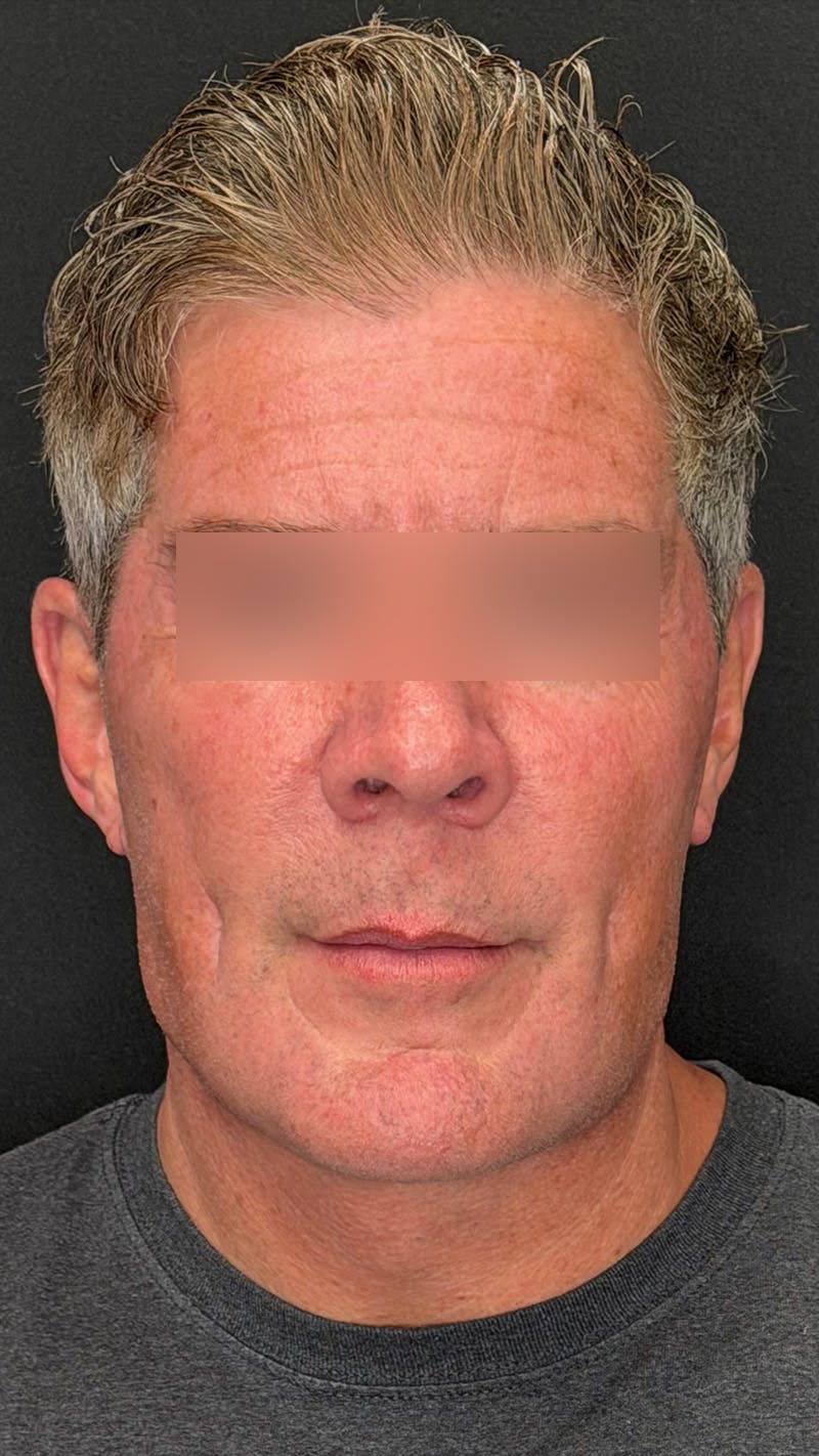 Cheek Implant Before & After Gallery - Patient 350990 - Image 2