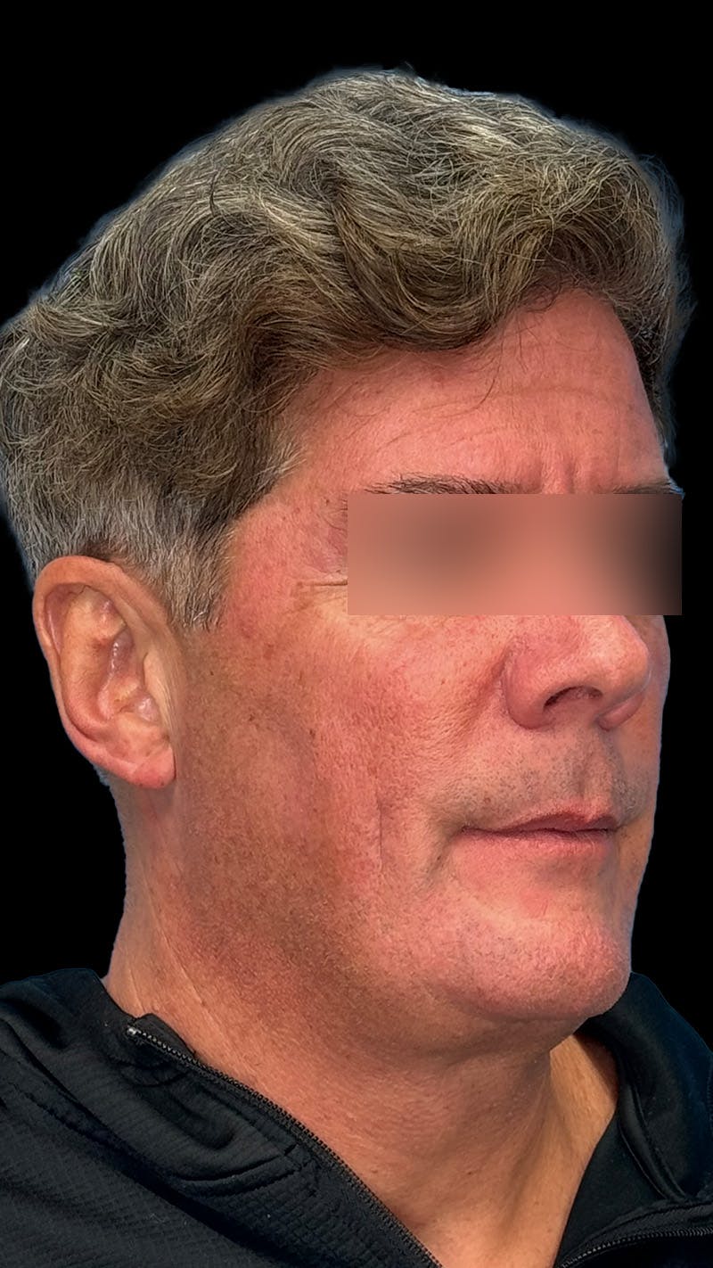 Cheek Implant Before & After Gallery - Patient 350990 - Image 3