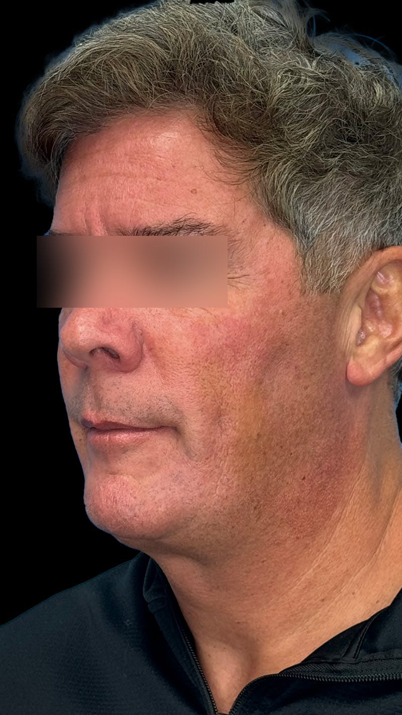 Cheek Implant Before & After Gallery - Patient 350990 - Image 7