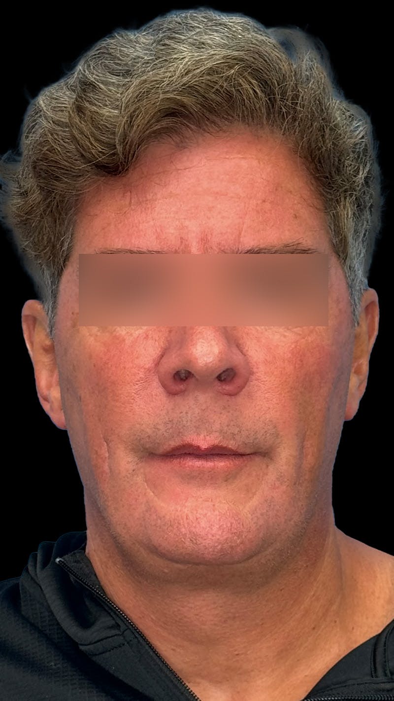 Cheek Implant Before & After Gallery - Patient 350990 - Image 1
