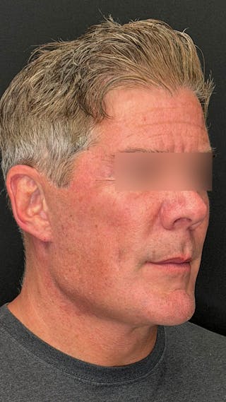 Cheek Implant Before & After Gallery - Patient 350990 - Image 4