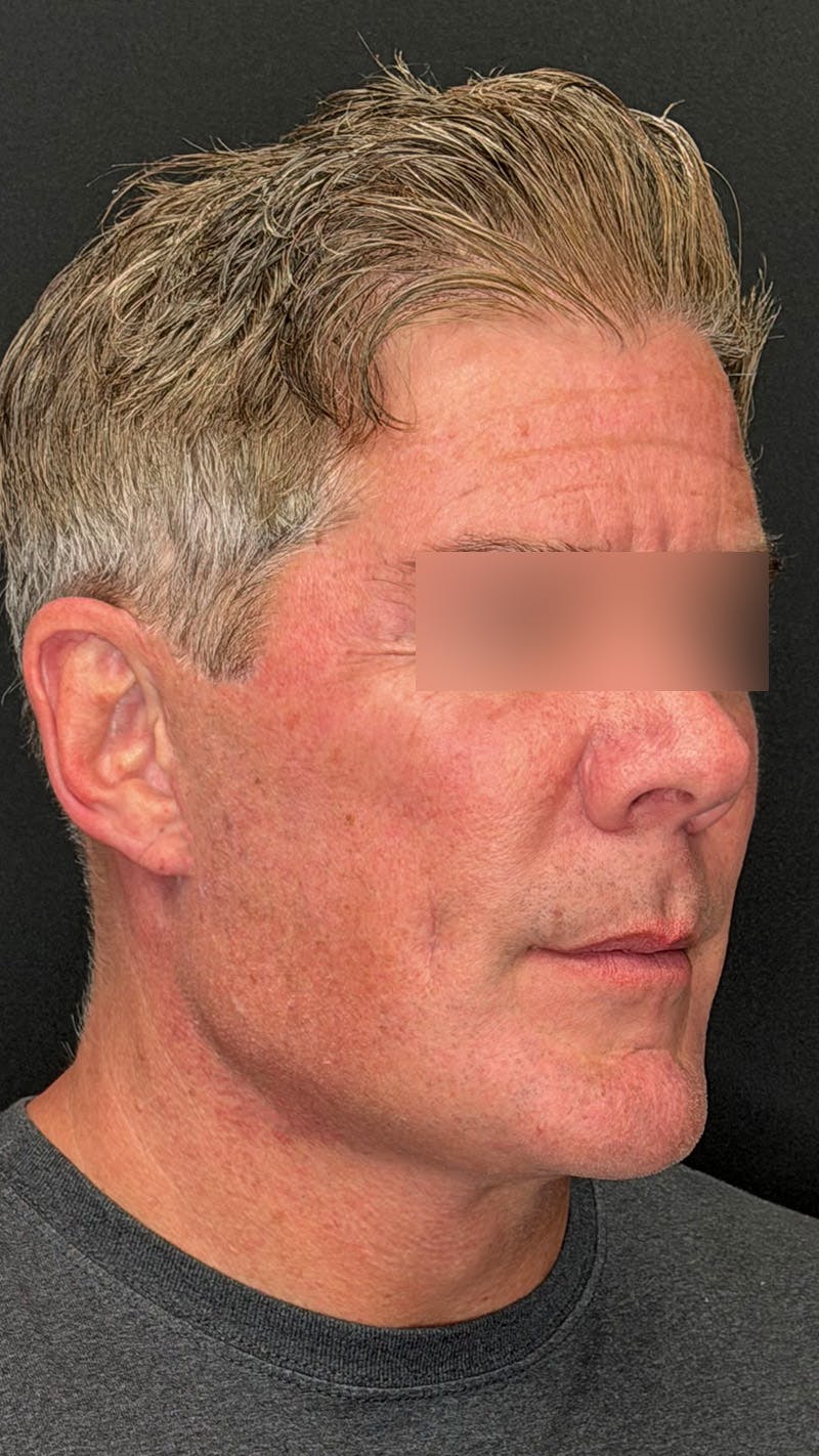 Cheek Implant Before & After Gallery - Patient 350990 - Image 4