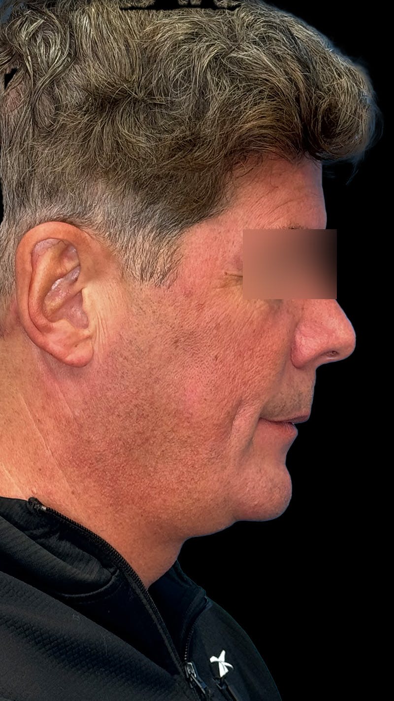 Cheek Implant Before & After Gallery - Patient 350990 - Image 5