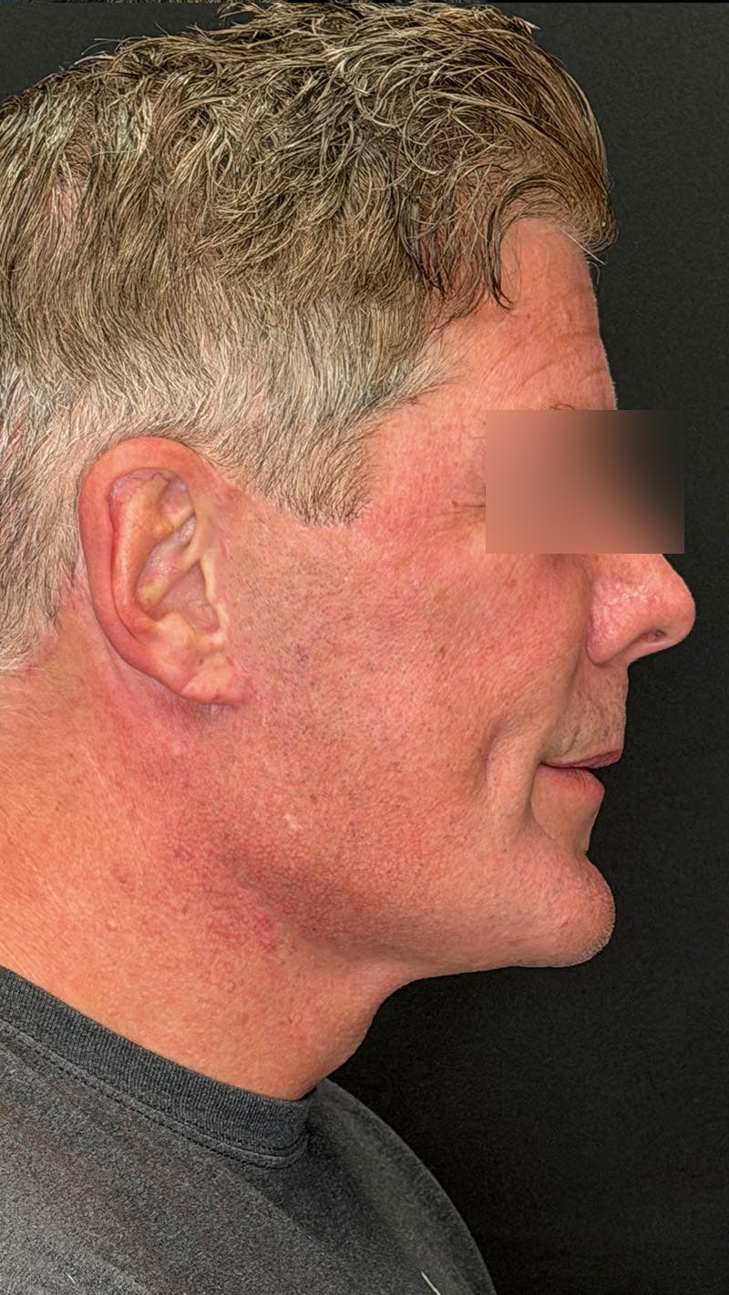 Cheek Implant Before & After Gallery - Patient 350990 - Image 6