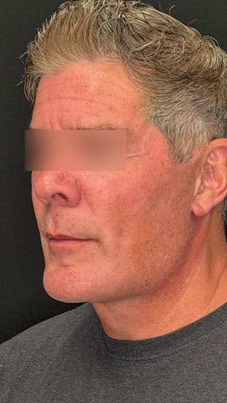 Cheek Implant Before & After Gallery - Patient 350990 - Image 8