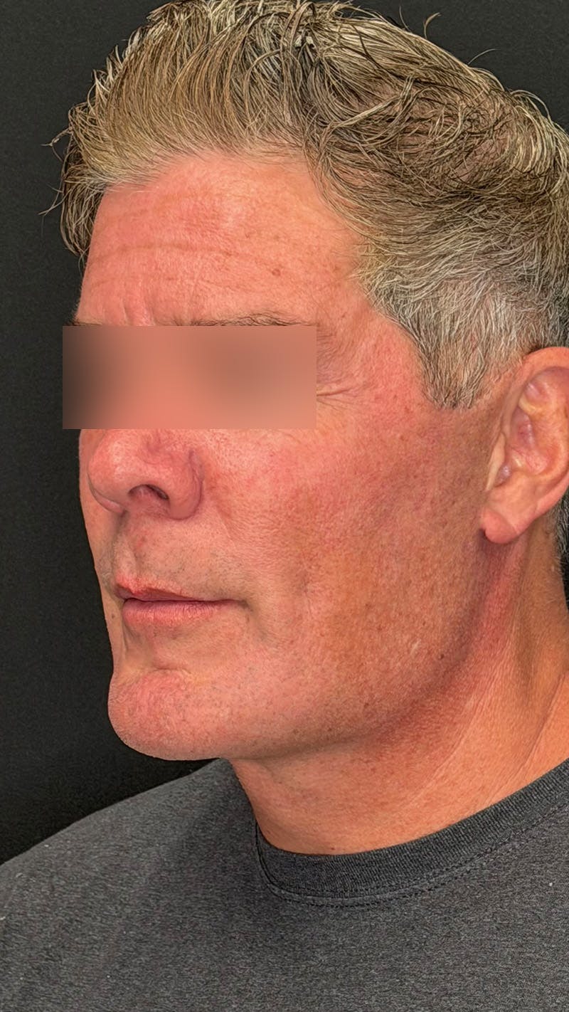 Cheek Implant Before & After Gallery - Patient 350990 - Image 8