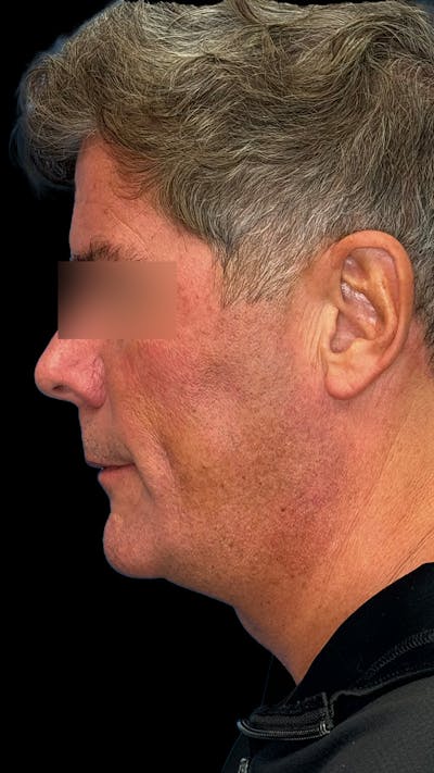 Mandibular Angle Implants Before & After Gallery - Patient 344735 - Image 1
