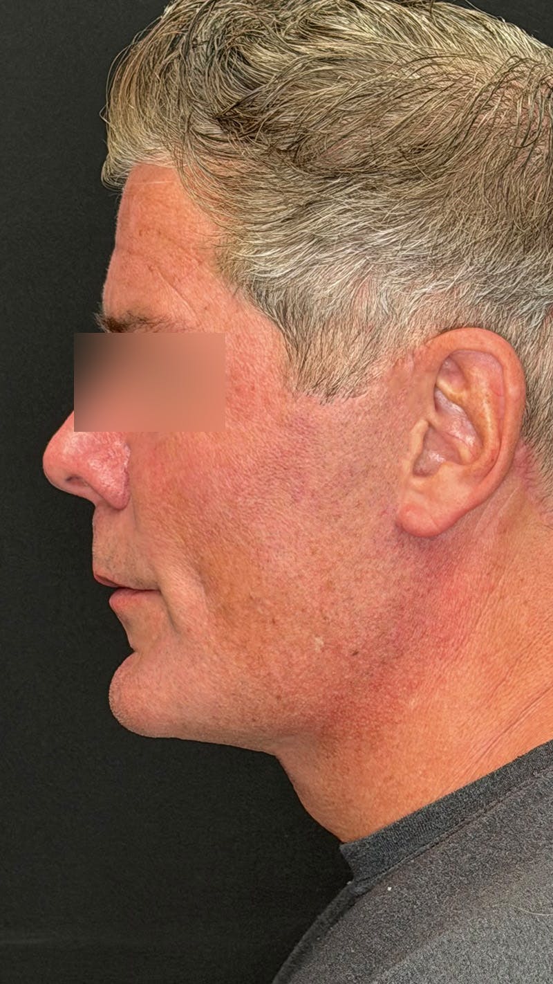 Cheek Implant Before & After Gallery - Patient 350990 - Image 10