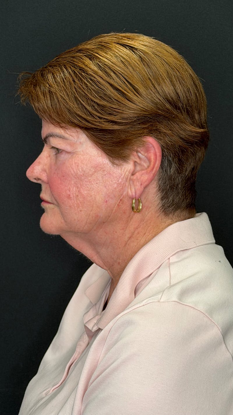 Deep Plane Facelift 70s Before & After Gallery - Patient 301165 - Image 7