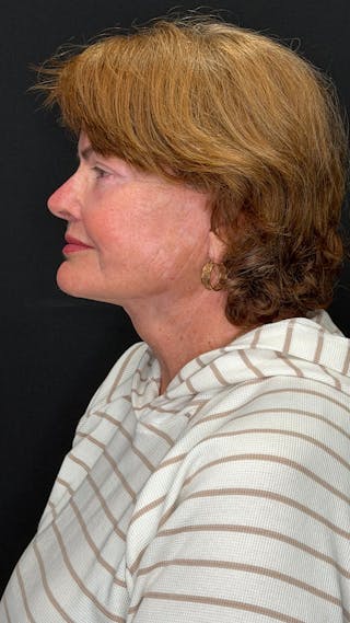 Deep Plane Facelift 70s Before & After Gallery - Patient 301165 - Image 8
