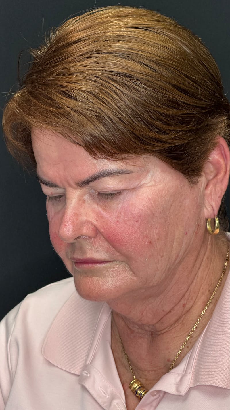 Deep Plane Facelift 70s Before & After Gallery - Patient 301165 - Image 9