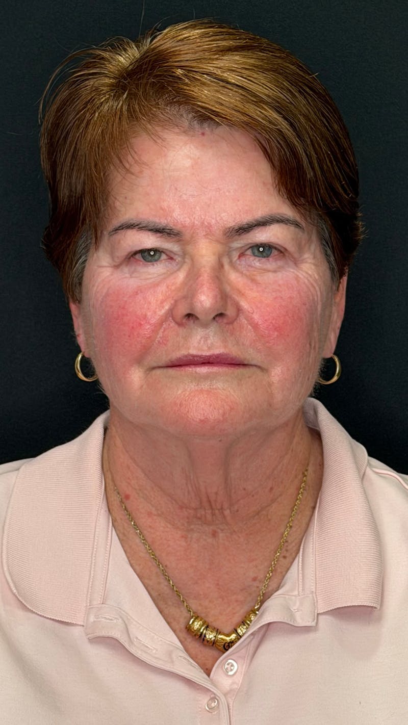 Deep Plane Facelift 70s Before & After Gallery - Patient 301165 - Image 1