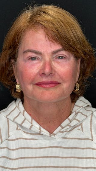 Deep Plane Facelift 70s Before & After Gallery - Patient 301165 - Image 2