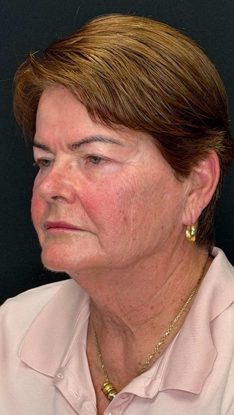 Deep Plane Facelift 70s Before & After Gallery - Patient 301165 - Image 3