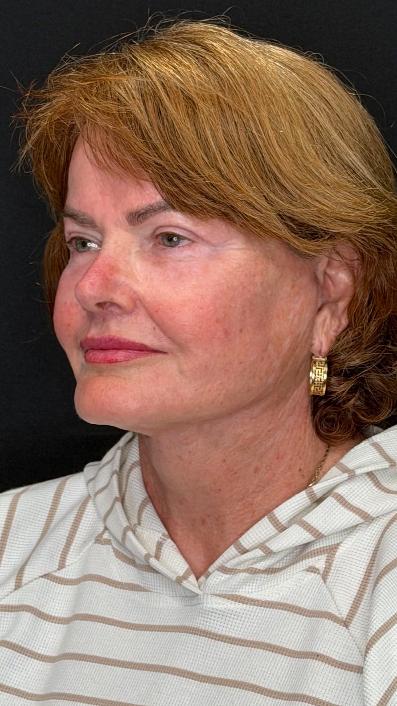 Deep Plane Facelift 70s Before & After Gallery - Patient 301165 - Image 4