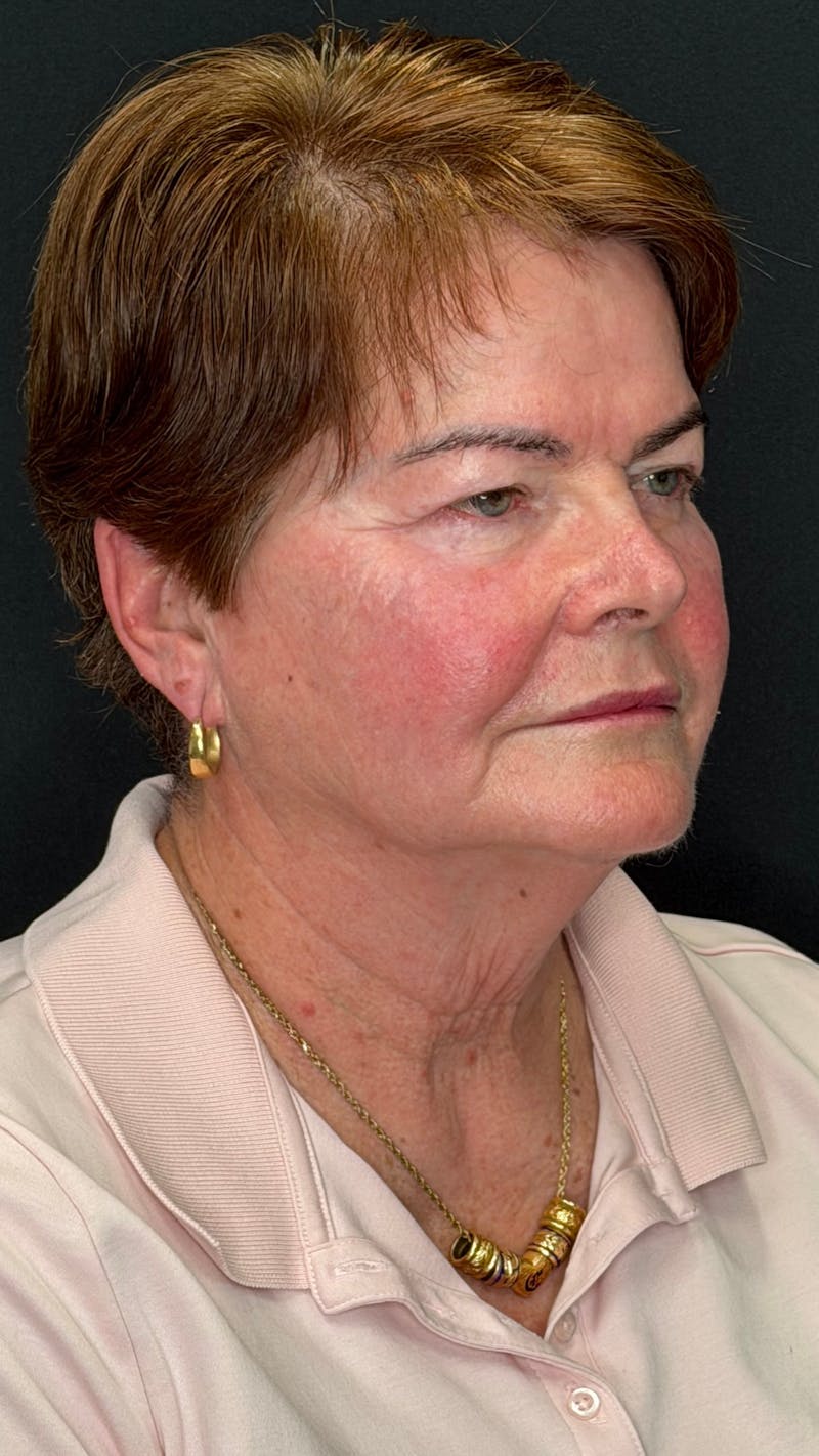 Deep Plane Facelift 70s Before & After Gallery - Patient 301165 - Image 5