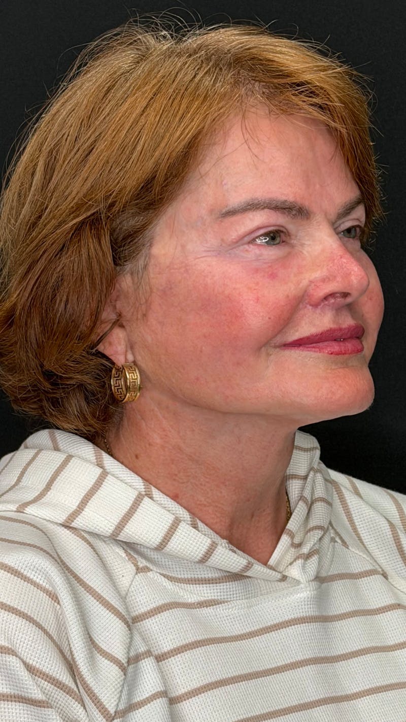 Deep Plane Facelift 70s Before & After Gallery - Patient 301165 - Image 6