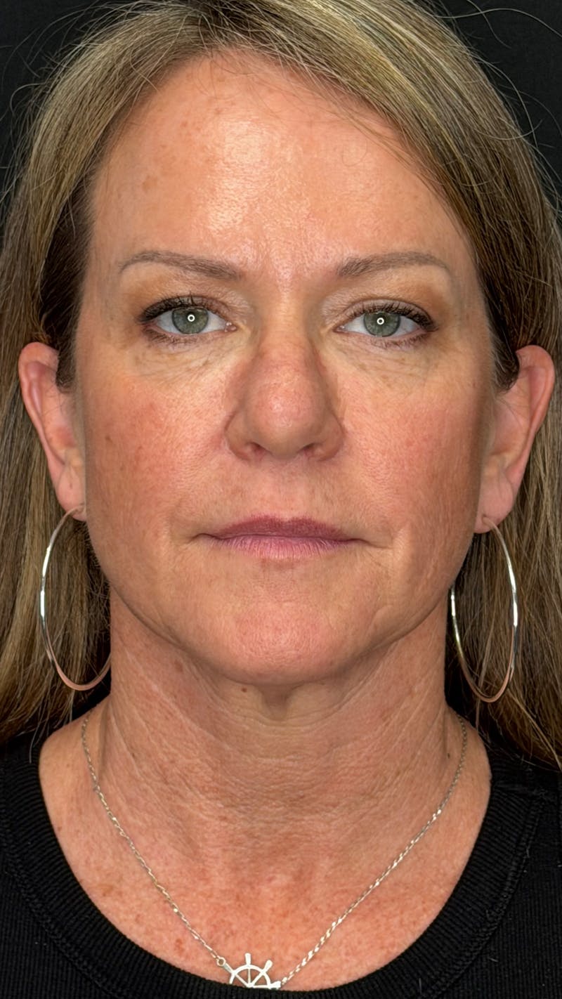 Deep Plane Facelift 40s Before & After Gallery - Patient 474259 - Image 1
