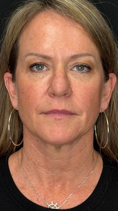 Deep Plane Facelift 40s Before & After Gallery - Patient 474259 - Image 1