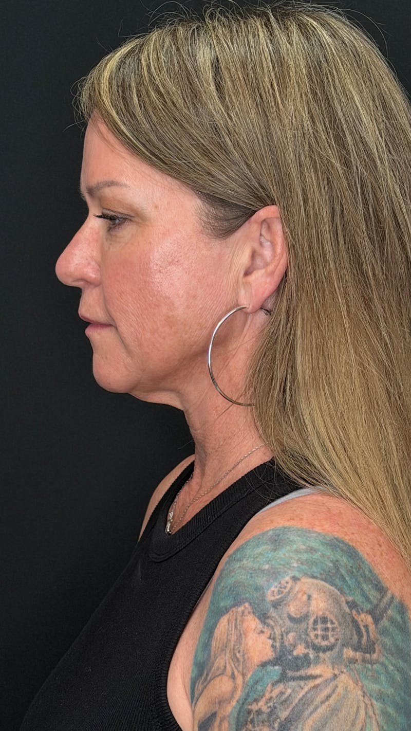 Deep Plane Facelift 40s Before & After Gallery - Patient 474259 - Image 7