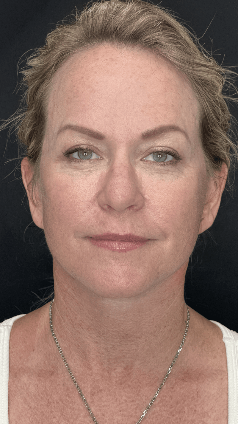Deep Plane Facelift 40s Before & After Gallery - Patient 474259 - Image 2
