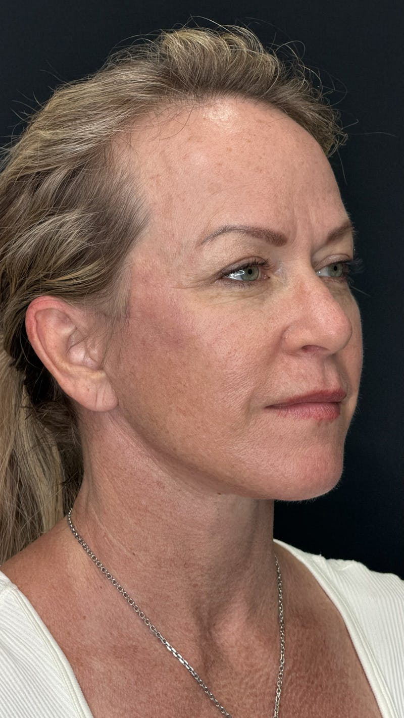 Deep Plane Facelift 40s Before & After Gallery - Patient 474259 - Image 6