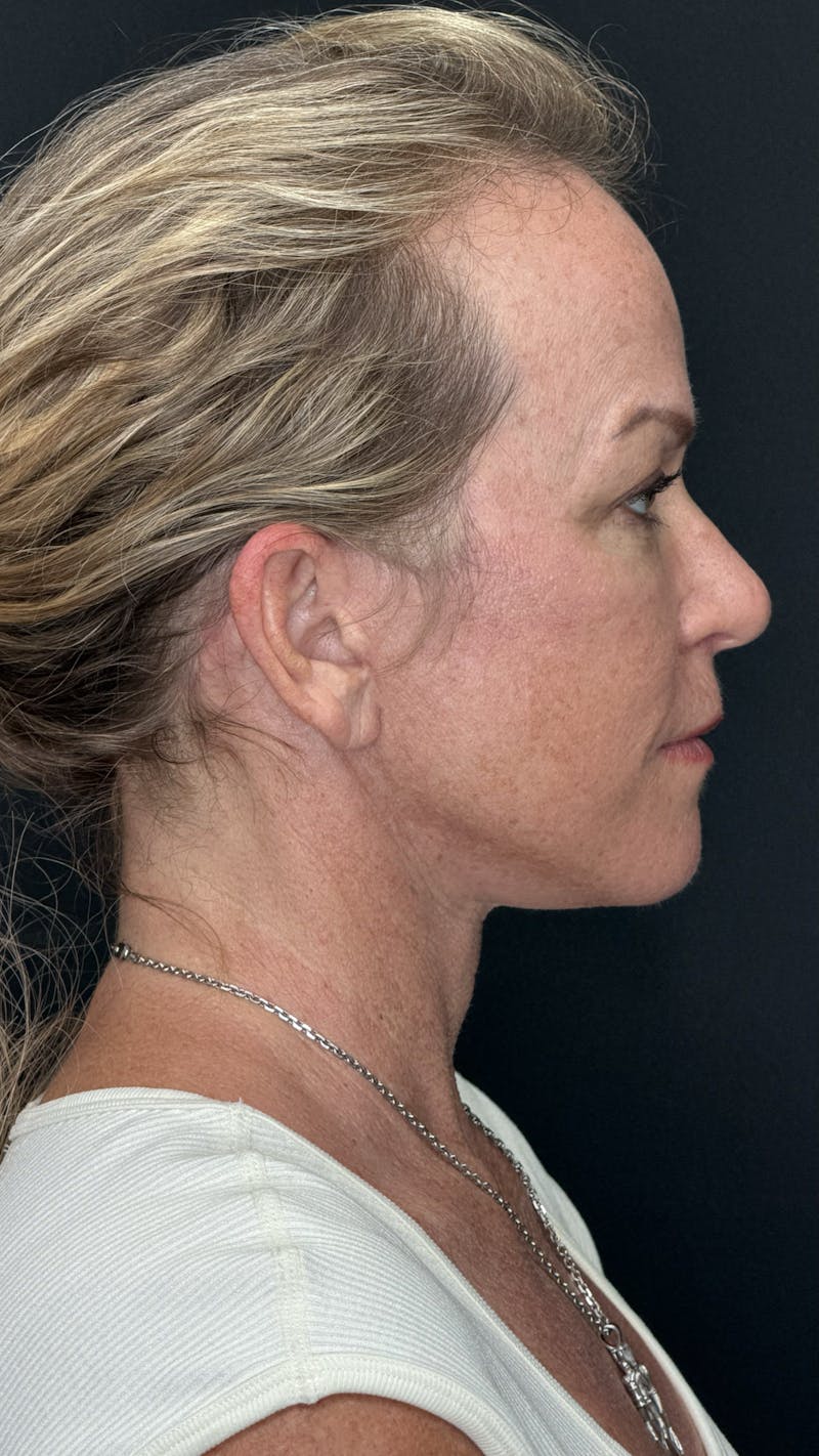 Deep Plane Facelift 40s Before & After Gallery - Patient 474259 - Image 4