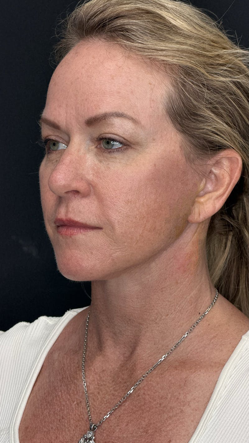 Deep Plane Facelift 40s Before & After Gallery - Patient 474259 - Image 10