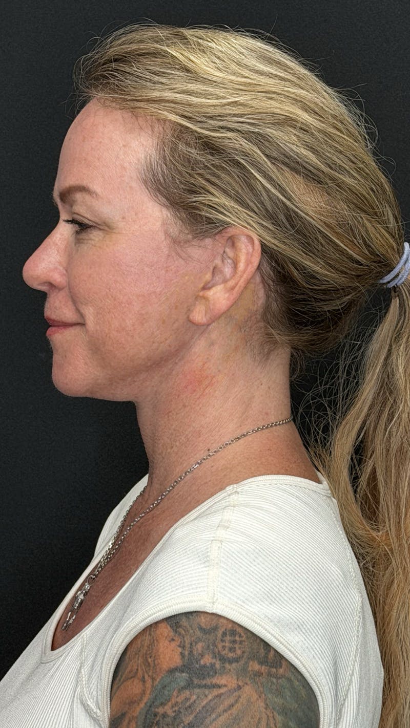 Deep Plane Facelift 40s Before & After Gallery - Patient 474259 - Image 8