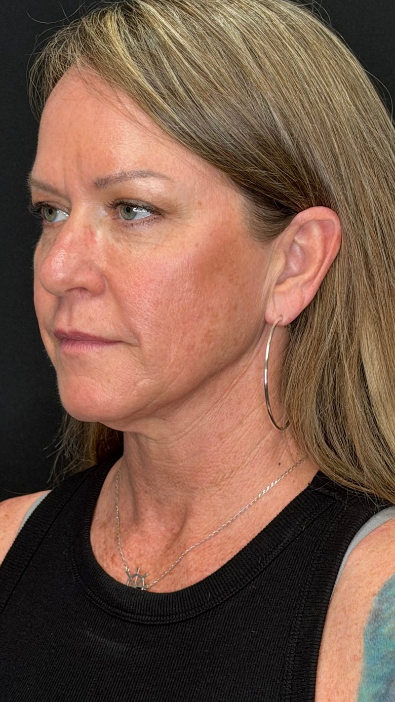 Deep Plane Facelift 40s Before & After Gallery - Patient 474259 - Image 9