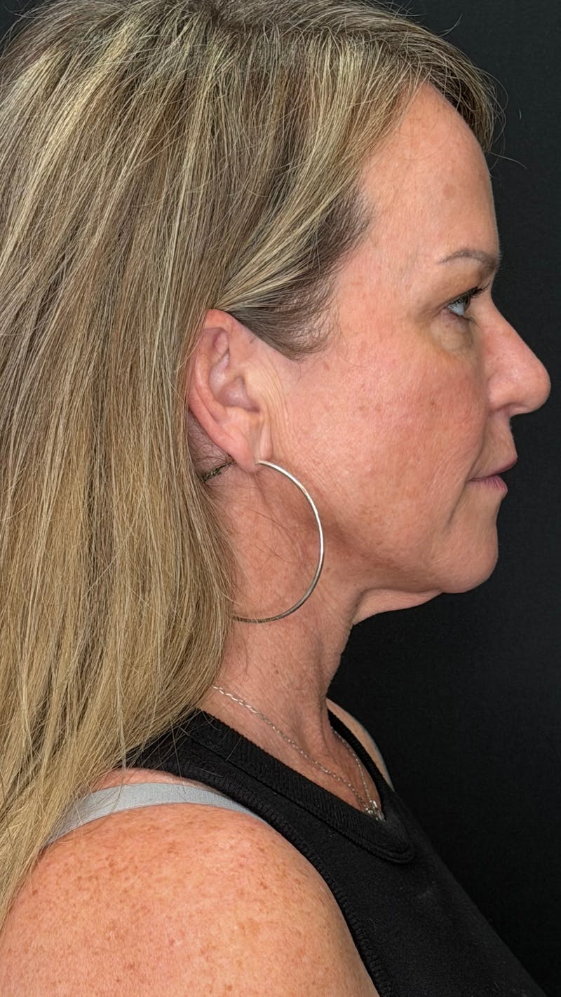 Deep Plane Facelift 40s Before & After Gallery - Patient 474259 - Image 3