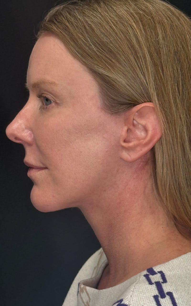 Deep Plane Facelift 50s Before & After Gallery - Patient 333058 - Image 10