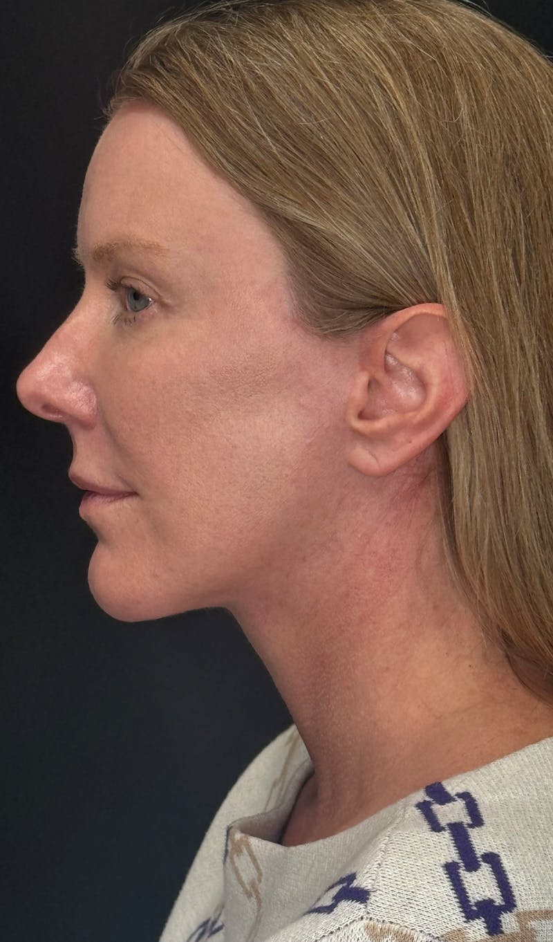 ContourLift Before & After Gallery - Patient 336554 - Image 10