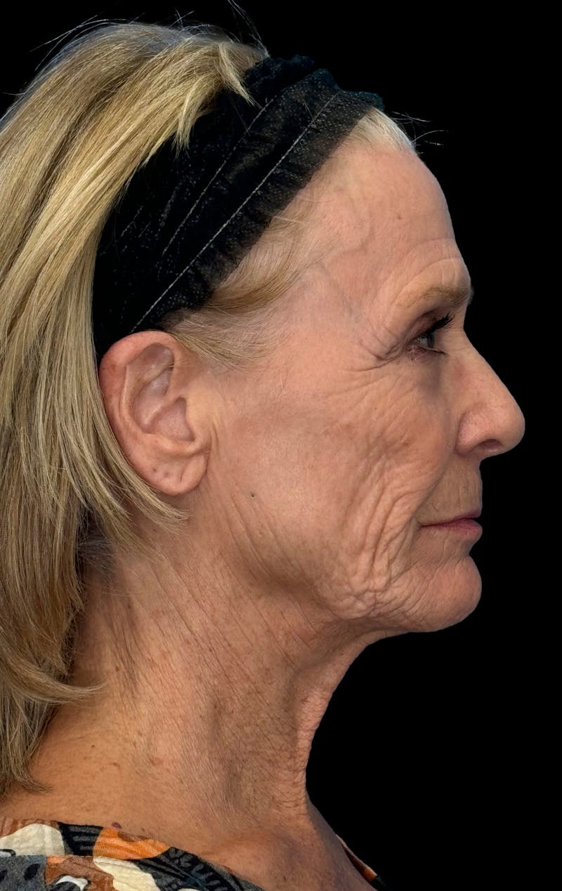 Lip Lift Before & After Gallery - Patient 206754 - Image 9