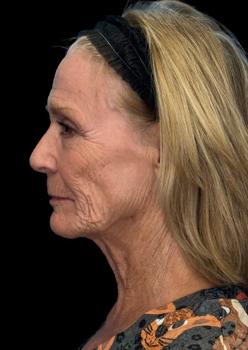 Laser Skin Resurfacing Before & After Gallery - Patient 192936 - Image 7
