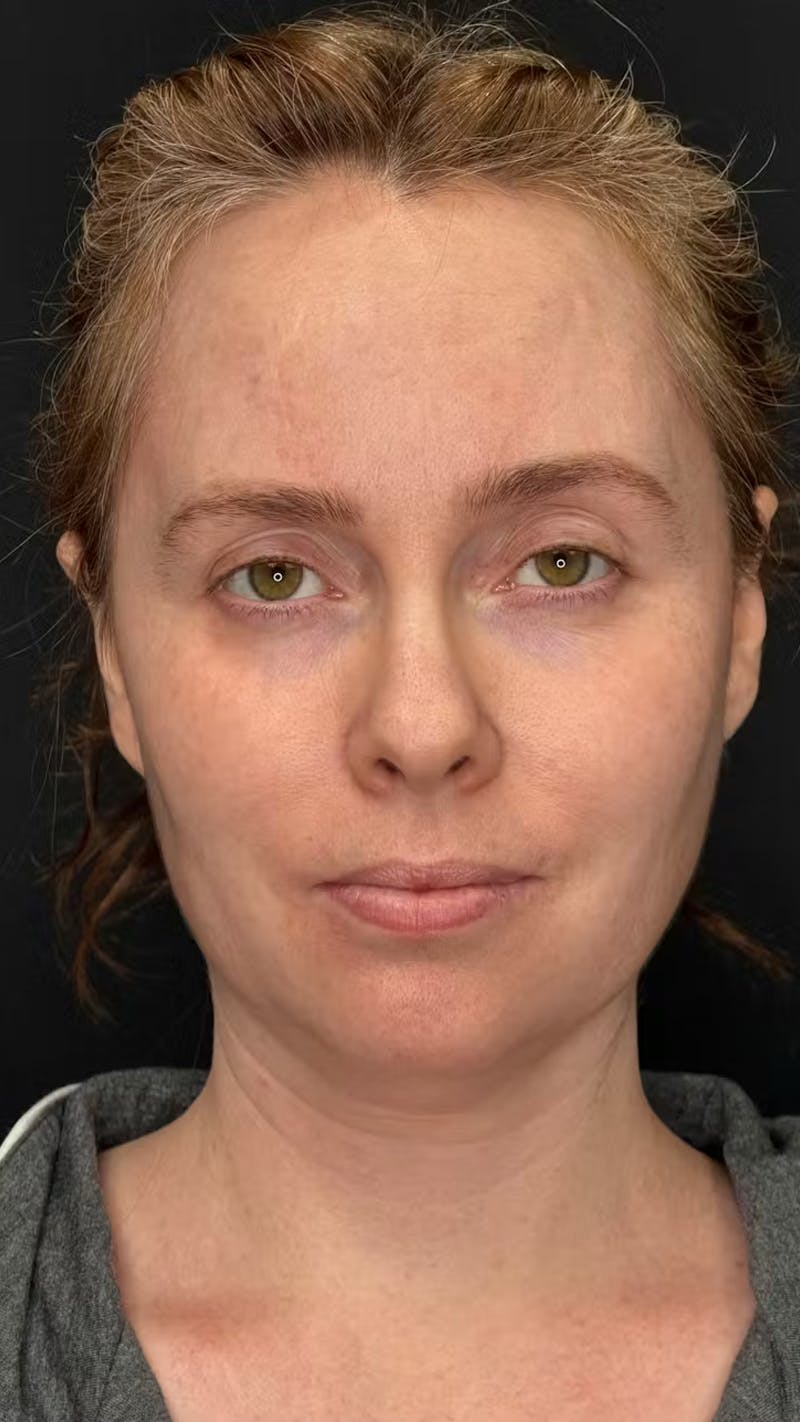 Deep Plane Facelift 40s Before & After Gallery - Patient 423590 - Image 1