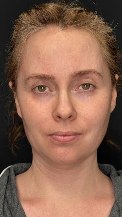 Deep Plane Facelift 40s Before & After Gallery - Patient 423590 - Image 1