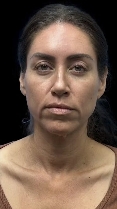 Deep Plane Facelift 40s Before & After Gallery - Patient 341532 - Image 1