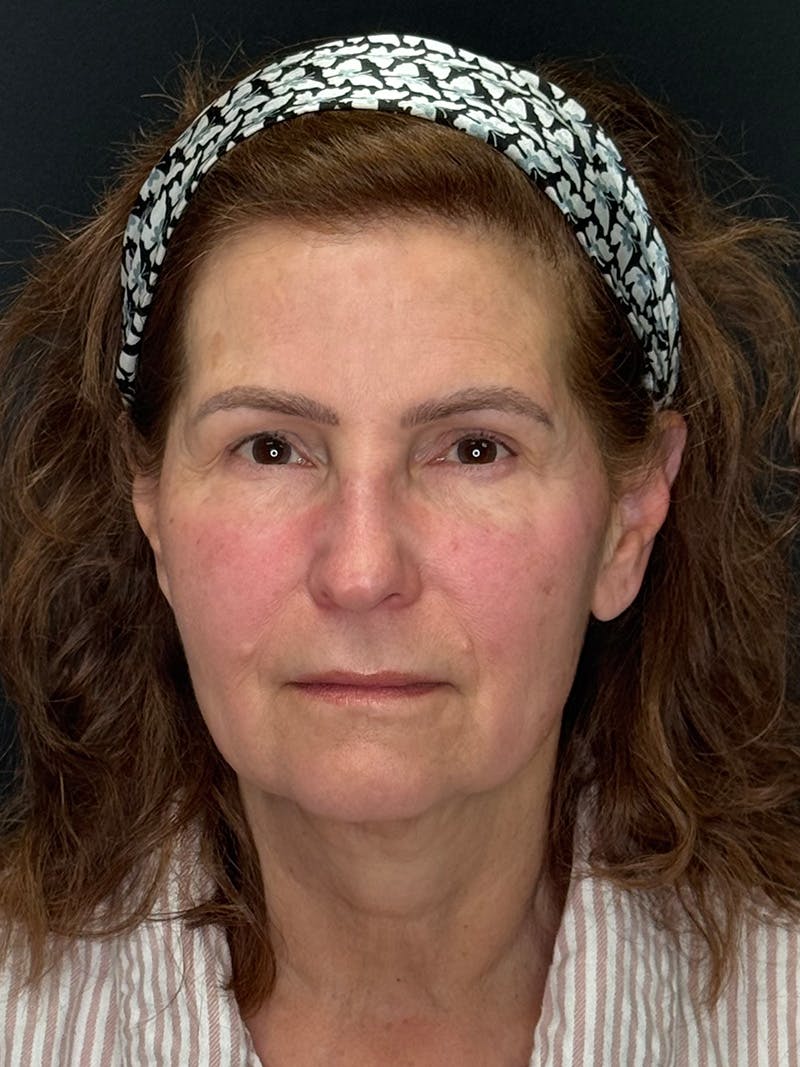 Deep Plane Facelift 60s Before & After Gallery - Patient 246083 - Image 1