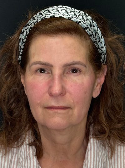 ContourLift Before & After Gallery - Patient 409453 - Image 1
