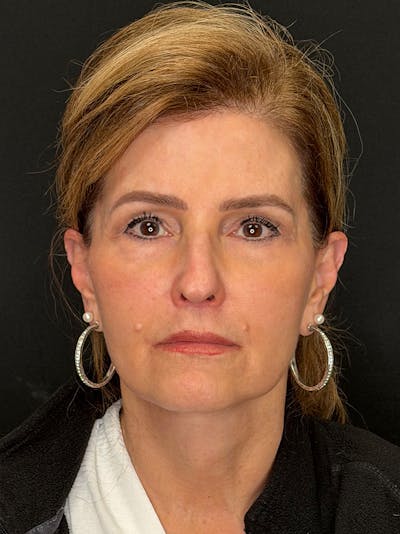 Deep Plane Facelift 60s Before & After Gallery - Patient 246083 - Image 2