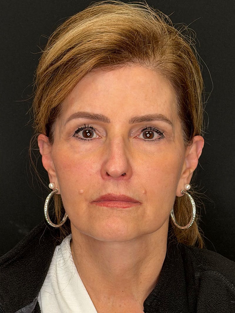 Deep Plane Facelift 60s Before & After Gallery - Patient 246083 - Image 2