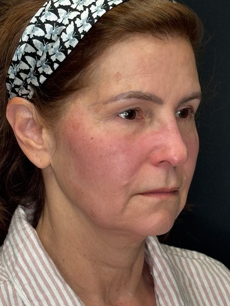 Deep Plane Facelift 60s Before & After Gallery - Patient 246083 - Image 3
