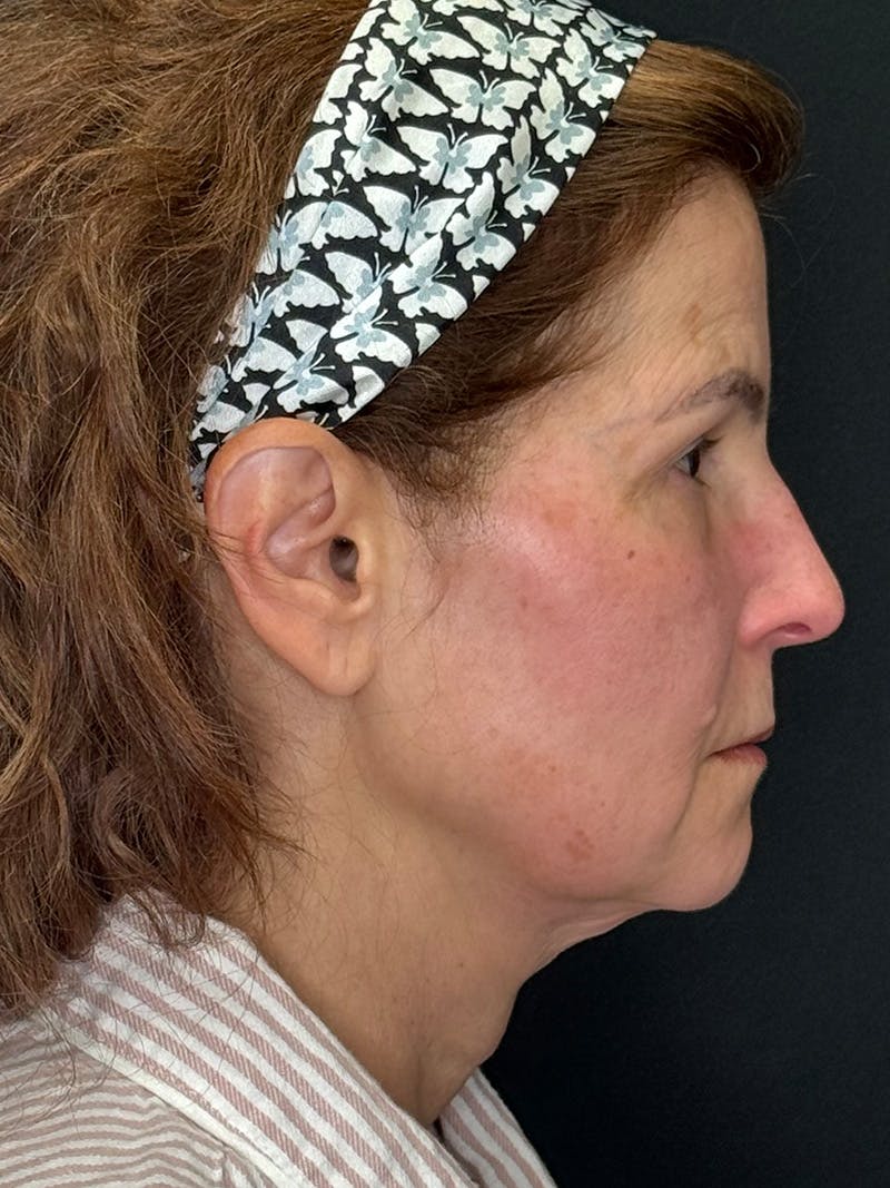 Deep Plane Facelift 60s Before & After Gallery - Patient 246083 - Image 5