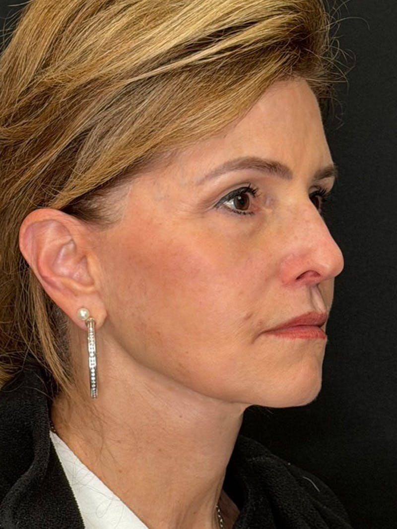 Deep Plane Facelift 60s Before & After Gallery - Patient 246083 - Image 4