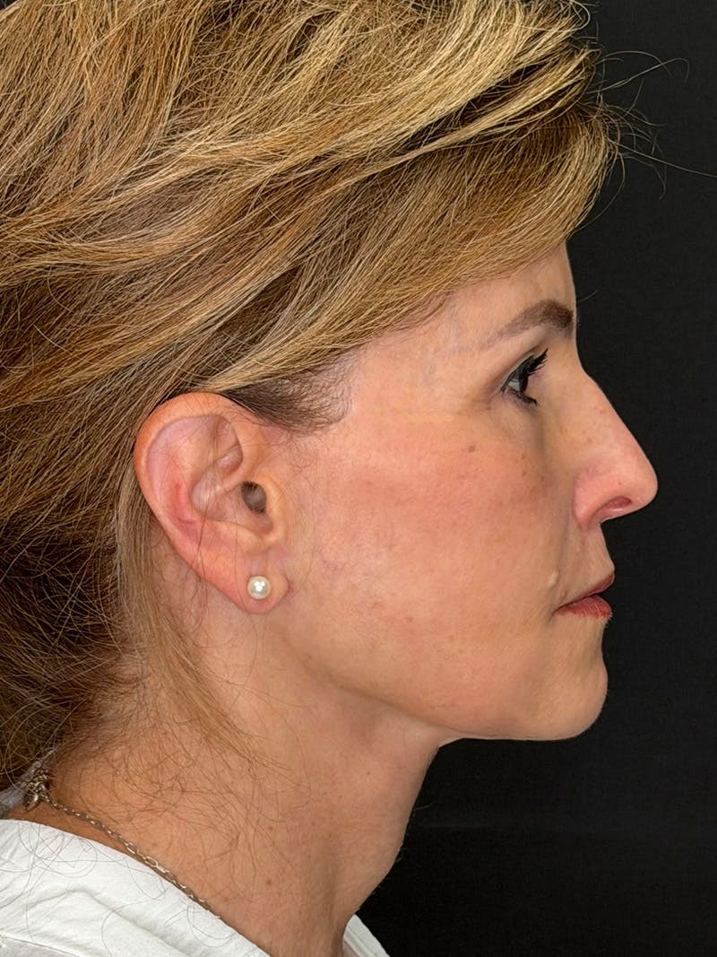 Deep Plane Facelift 60s Before & After Gallery - Patient 246083 - Image 6