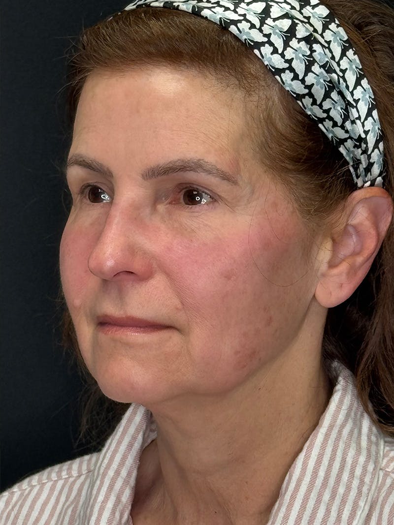 Deep Plane Facelift 60s Before & After Gallery - Patient 246083 - Image 7